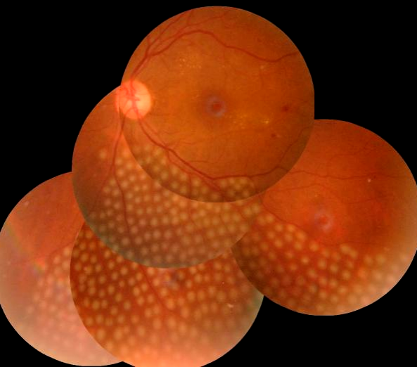 眼底激光机有什么牌子新技术新设备助推医院眼科前行——眼科开展“视网膜激光光凝术”新项目_https://www.jmylbn.com_新闻资讯_第7张