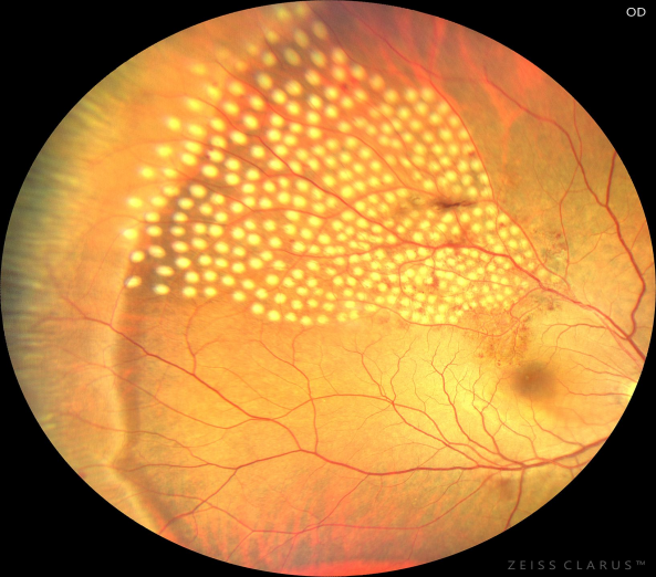 眼底激光机有什么牌子新技术新设备助推医院眼科前行——眼科开展“视网膜激光光凝术”新项目_https://www.jmylbn.com_新闻资讯_第12张