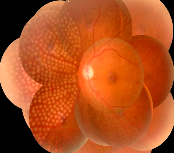 眼底激光机有什么牌子新技术新设备助推医院眼科前行——眼科开展“视网膜激光光凝术”新项目_https://www.jmylbn.com_新闻资讯_第9张