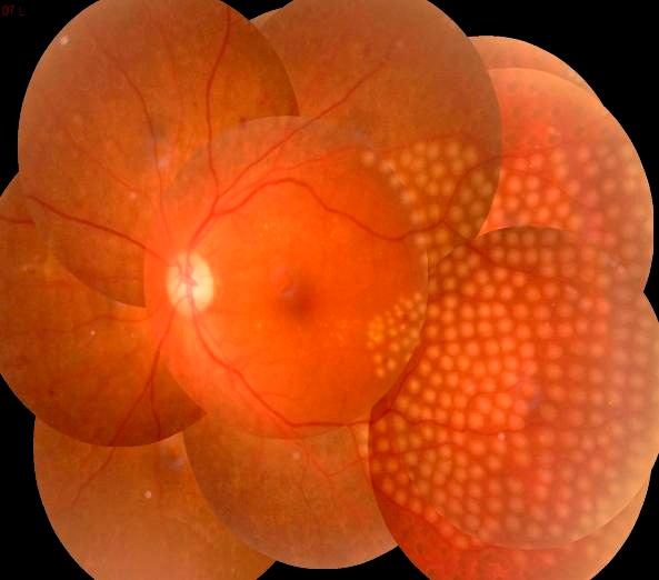 眼底激光机有什么牌子新技术新设备助推医院眼科前行——眼科开展“视网膜激光光凝术”新项目_https://www.jmylbn.com_新闻资讯_第10张