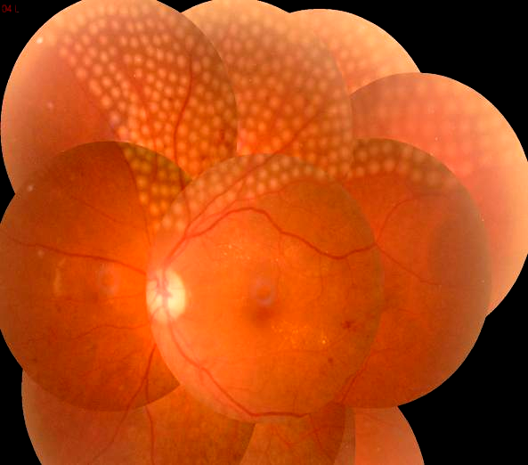 眼底激光机有什么牌子新技术新设备助推医院眼科前行——眼科开展“视网膜激光光凝术”新项目_https://www.jmylbn.com_新闻资讯_第8张