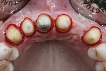 近些年大火的BOPT预备技术技术，你真的会吗？
