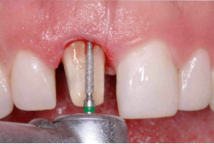 近些年大火的BOPT预备技术技术，你真的会吗？