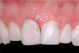 近些年大火的BOPT预备技术技术，你真的会吗？