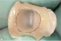 近些年大火的BOPT预备技术技术，你真的会吗？