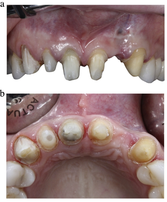 近些年大火的BOPT预备技术技术，你真的会吗？