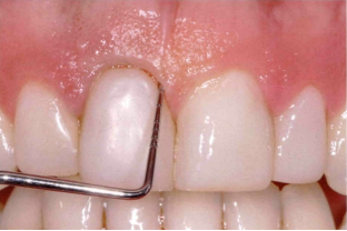 近些年大火的BOPT预备技术技术，你真的会吗？