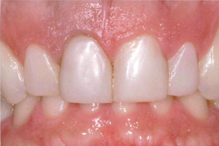 近些年大火的BOPT预备技术技术，你真的会吗？