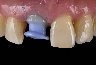 近些年大火的BOPT预备技术技术，你真的会吗？