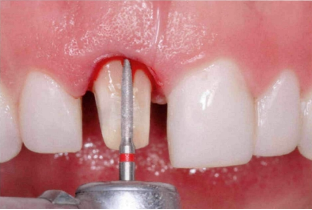 近些年大火的BOPT预备技术技术，你真的会吗？
