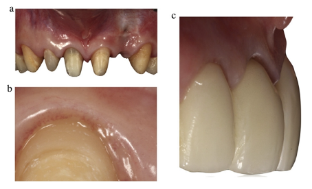 近些年大火的BOPT预备技术技术，你真的会吗？