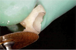 近些年大火的BOPT预备技术技术，你真的会吗？