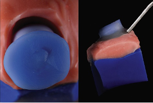近些年大火的BOPT预备技术技术，你真的会吗？