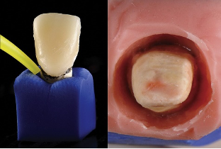 近些年大火的BOPT预备技术技术，你真的会吗？