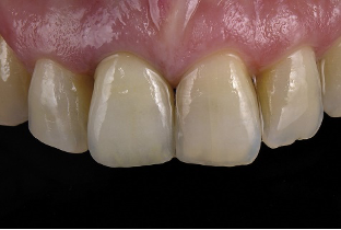 近些年大火的BOPT预备技术技术，你真的会吗？