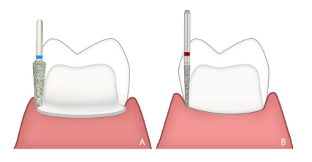 近些年大火的BOPT预备技术技术，你真的会吗？
