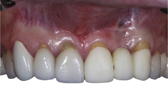 近些年大火的BOPT预备技术技术，你真的会吗？