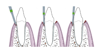近些年大火的BOPT预备技术技术，你真的会吗？