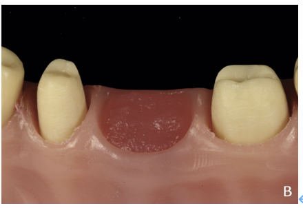 近些年大火的BOPT预备技术技术，你真的会吗？