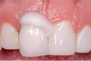 近些年大火的BOPT预备技术技术，你真的会吗？