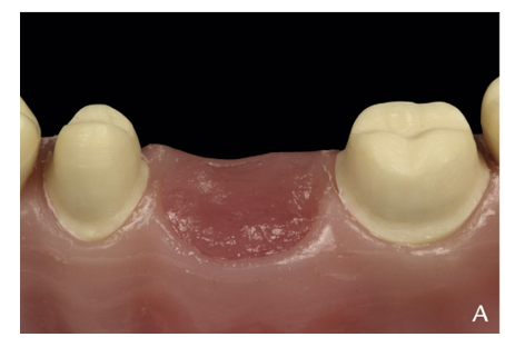 近些年大火的BOPT预备技术技术，你真的会吗？