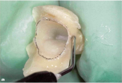 近些年大火的BOPT预备技术技术，你真的会吗？
