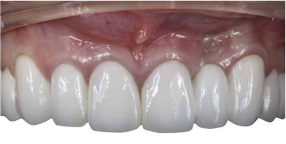 近些年大火的BOPT预备技术技术，你真的会吗？