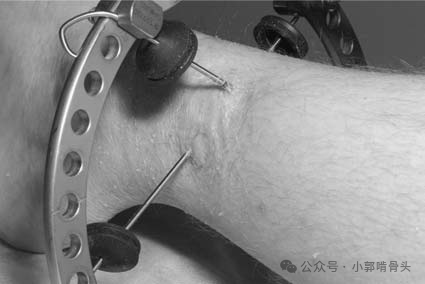 医用钢针是什么骨科精读 ｜ 医用橡胶塞减少外固定针钉道感染_https://www.jmylbn.com_新闻资讯_第14张