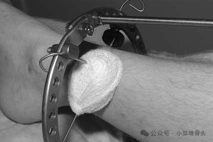 医用钢针是什么骨科精读 ｜ 医用橡胶塞减少外固定针钉道感染_https://www.jmylbn.com_新闻资讯_第18张