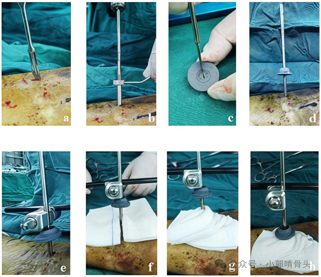 医用钢针是什么骨科精读 ｜ 医用橡胶塞减少外固定针钉道感染_https://www.jmylbn.com_新闻资讯_第4张