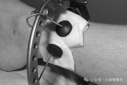 医用钢针是什么骨科精读 ｜ 医用橡胶塞减少外固定针钉道感染_https://www.jmylbn.com_新闻资讯_第16张