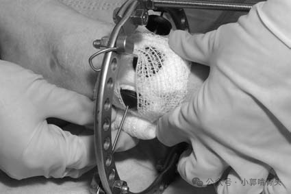 医用钢针是什么骨科精读 ｜ 医用橡胶塞减少外固定针钉道感染_https://www.jmylbn.com_新闻资讯_第17张