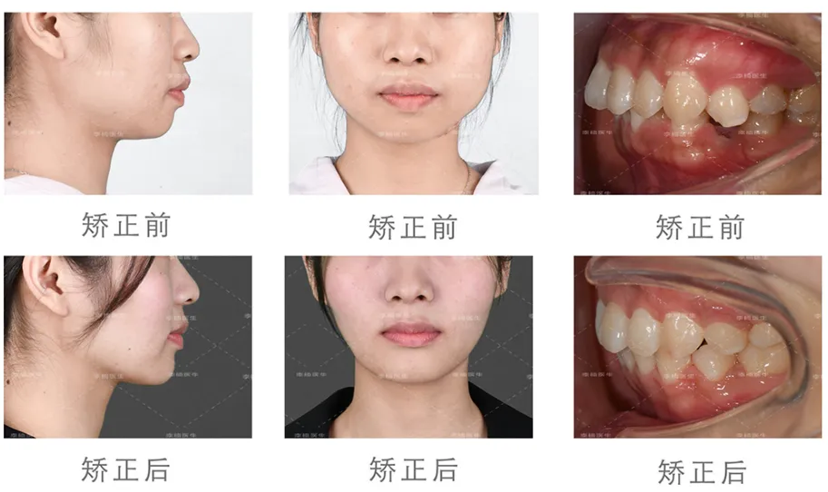 “C”位领衔!李楠院长担纲「时代天使菁英讲师」,推动国内隐形行业迈向未来! “C”位领衔!李楠院长担纲「时代天使菁英讲师」,推动国内隐形行业迈向未来!