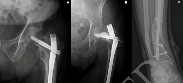 断裂髓内钉取出术--橄榄头导丝加小螺钉的妙用