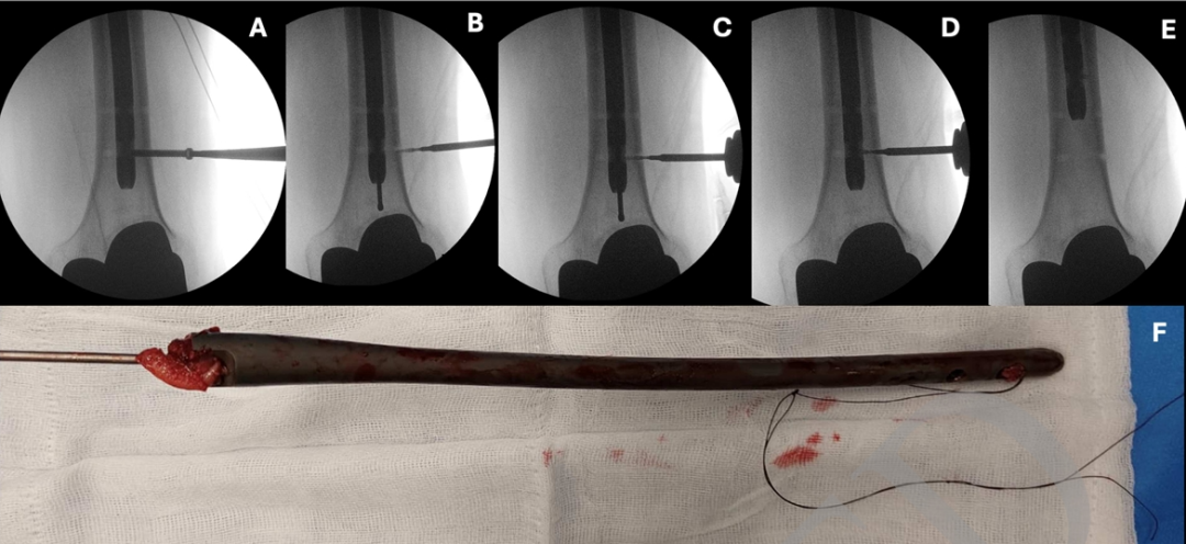 断裂髓内钉取出术--橄榄头导丝加小螺钉的妙用