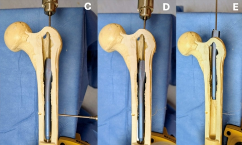 断裂髓内钉取出术--橄榄头导丝加小螺钉的妙用