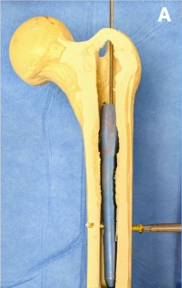 断裂髓内钉取出术--橄榄头导丝加小螺钉的妙用