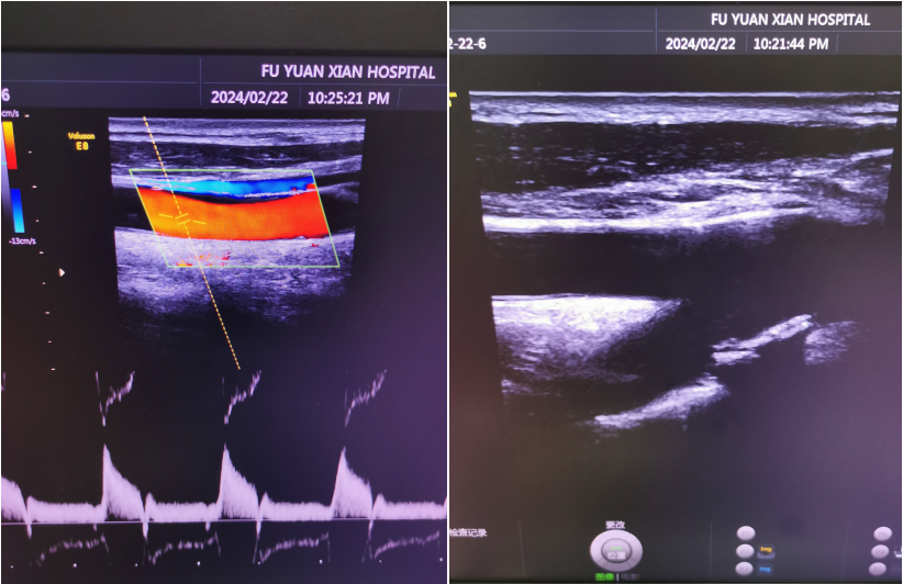 超声中什么黑什么白超声“黑白”和“彩色”有什么区别？_https://www.jmylbn.com_新闻资讯_第4张
