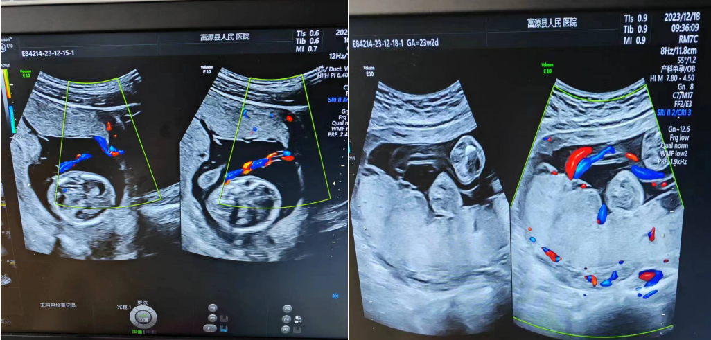 超声中什么黑什么白超声“黑白”和“彩色”有什么区别？_https://www.jmylbn.com_新闻资讯_第5张