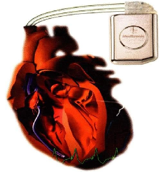 除颤器有什么用心脏电复律及除颤器的使用_https://www.jmylbn.com_新闻资讯_第2张