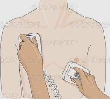 除颤器有什么用心脏电复律及除颤器的使用_https://www.jmylbn.com_新闻资讯_第1张