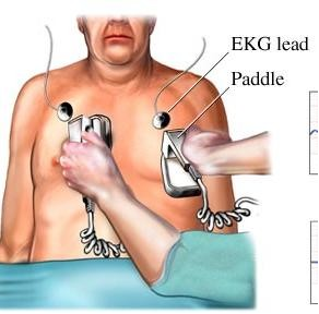 除颤器有什么用心脏电复律及除颤器的使用_https://www.jmylbn.com_新闻资讯_第9张
