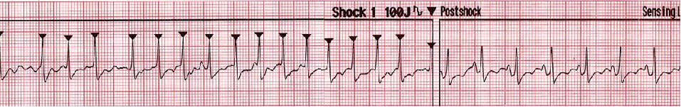 除颤器有什么用心脏电复律及除颤器的使用_https://www.jmylbn.com_新闻资讯_第10张