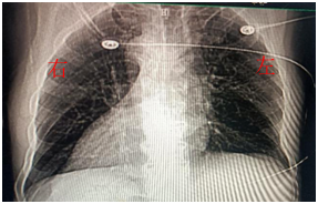 房山区第一医院成功救治一例罕见"镜像右位心合并不稳定性心绞痛"患者
