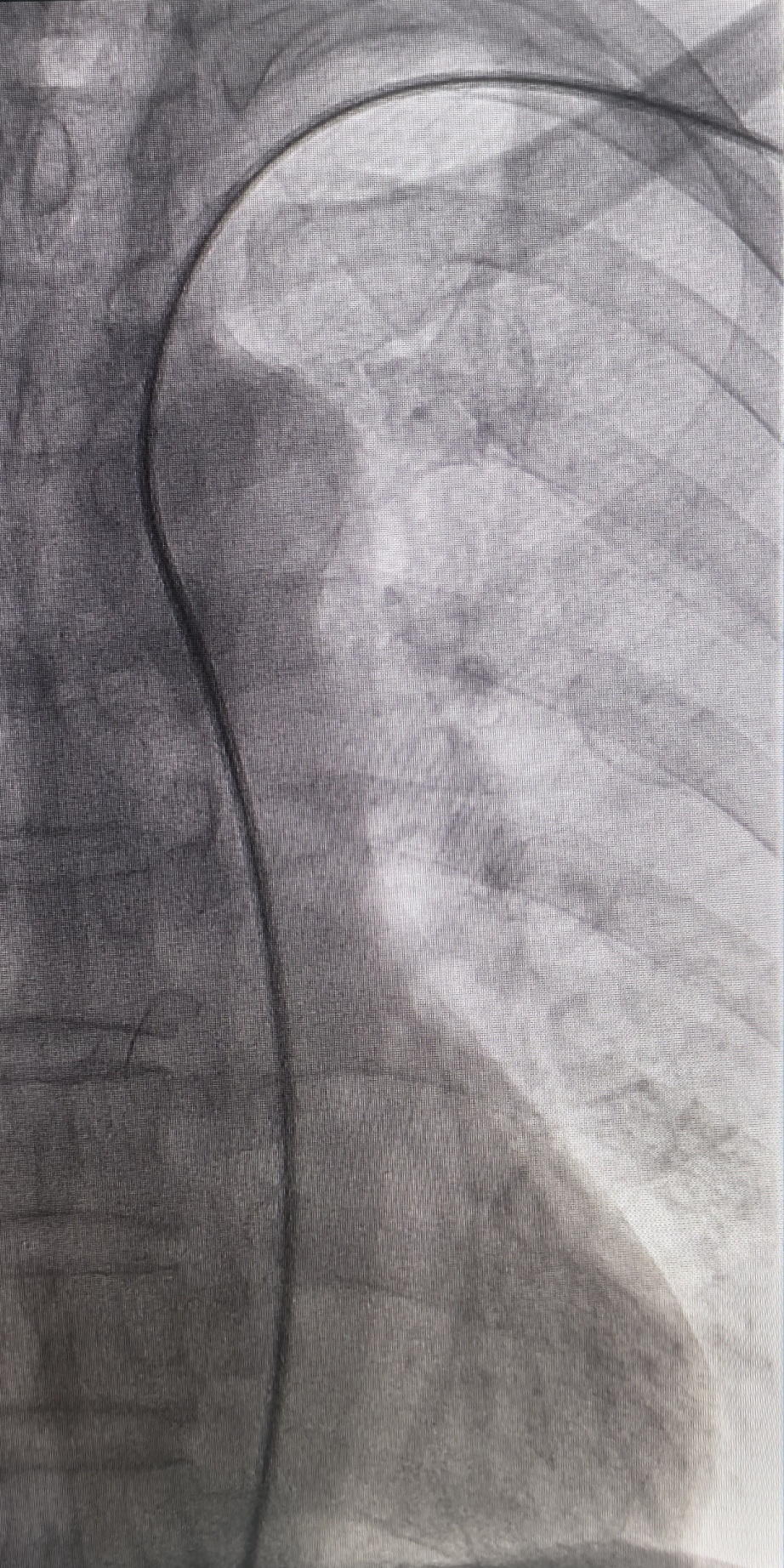 动脉长鞘怎么置入桡胜一筹丨吴巍巍主任、赵俊来教授团队：应用Brite Tip RADIANZ长鞘经桡动脉治疗下肢动脉粥样硬化闭塞症一例_https://www.jmylbn.com_新闻资讯_第18张