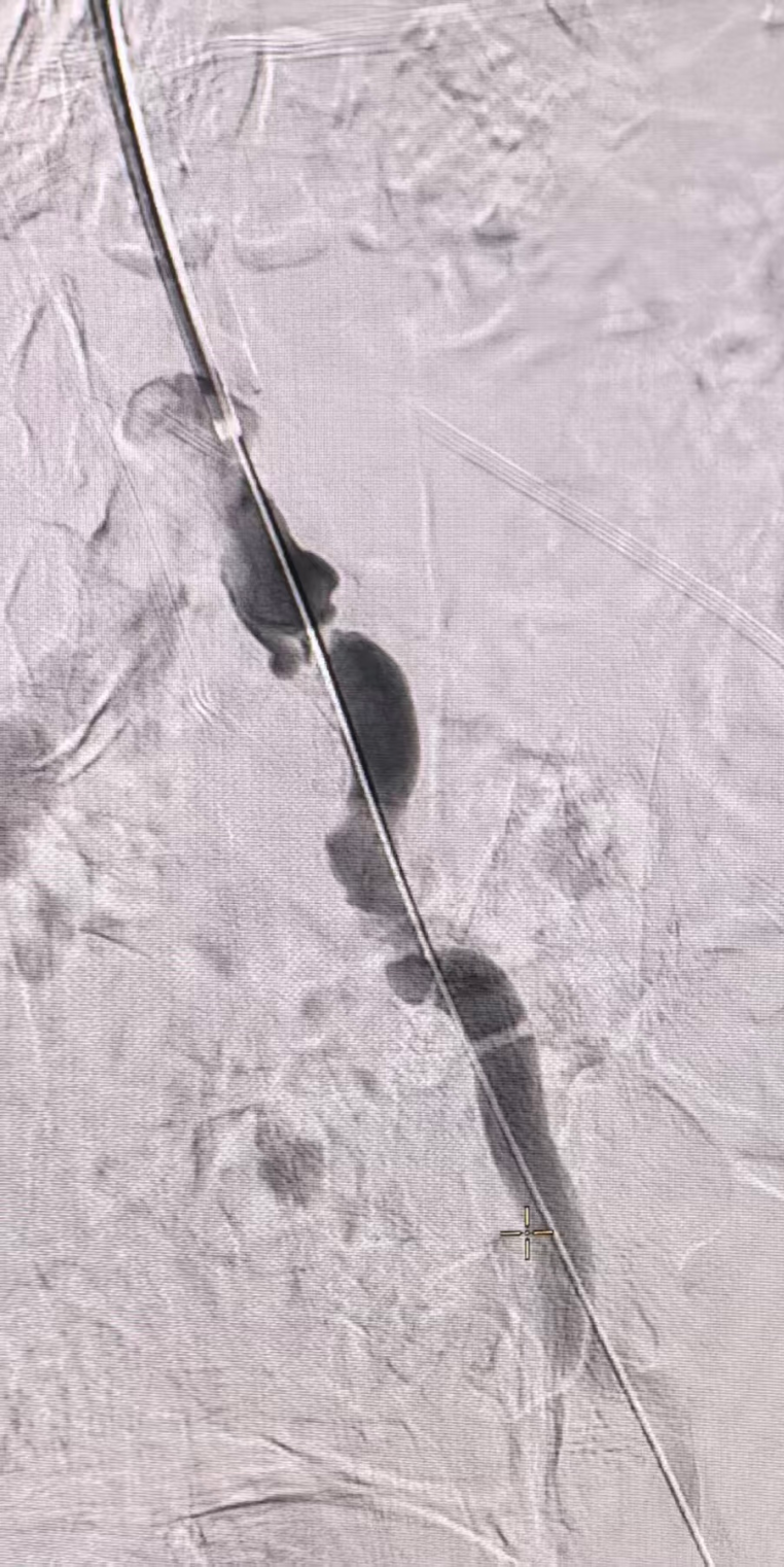 动脉长鞘怎么置入桡胜一筹丨吴巍巍主任、赵俊来教授团队：应用Brite Tip RADIANZ长鞘经桡动脉治疗下肢动脉粥样硬化闭塞症一例_https://www.jmylbn.com_新闻资讯_第19张