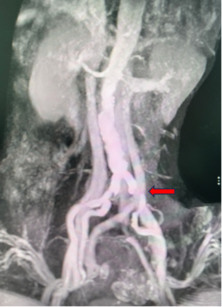 动脉长鞘怎么置入桡胜一筹丨吴巍巍主任、赵俊来教授团队：应用Brite Tip RADIANZ长鞘经桡动脉治疗下肢动脉粥样硬化闭塞症一例_https://www.jmylbn.com_新闻资讯_第8张