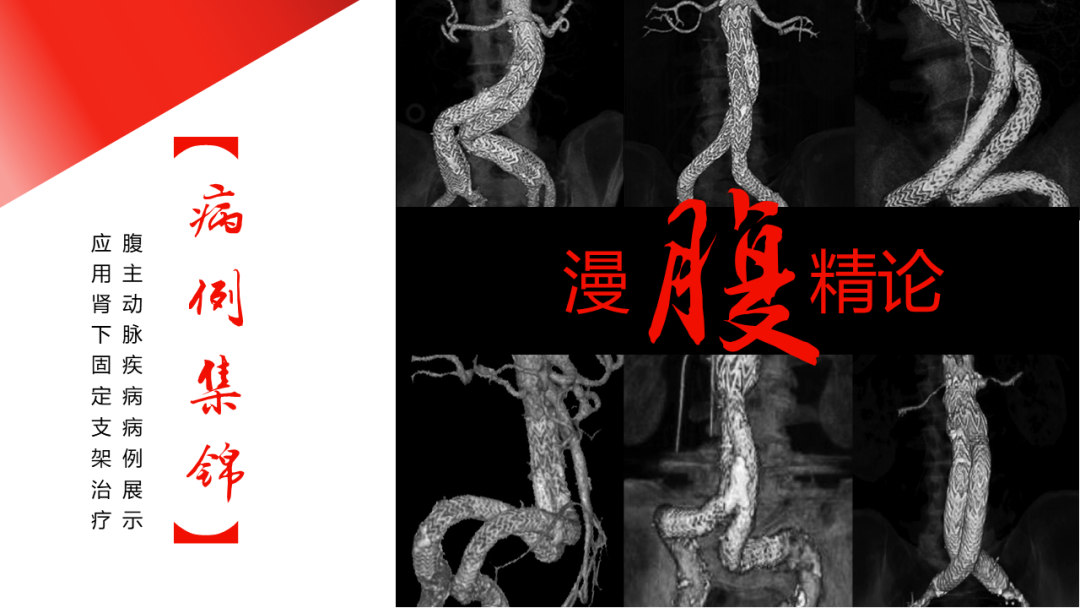 gore医疗怎么样「漫腹精论」独具匠心 推陈出新——同侧IBE支架内翻山重建髂内动脉治疗EVAR术后内漏病例报道_https://www.jmylbn.com_新闻资讯_第2张