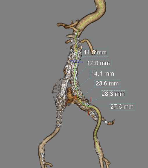 gore医疗怎么样「漫腹精论」独具匠心 推陈出新——同侧IBE支架内翻山重建髂内动脉治疗EVAR术后内漏病例报道_https://www.jmylbn.com_新闻资讯_第8张