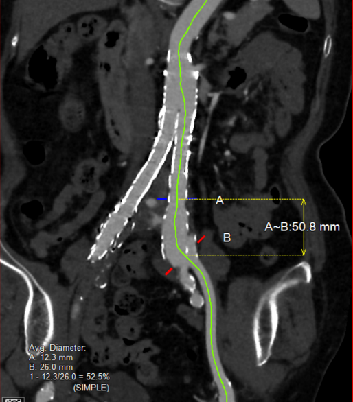gore医疗怎么样「漫腹精论」独具匠心 推陈出新——同侧IBE支架内翻山重建髂内动脉治疗EVAR术后内漏病例报道_https://www.jmylbn.com_新闻资讯_第9张